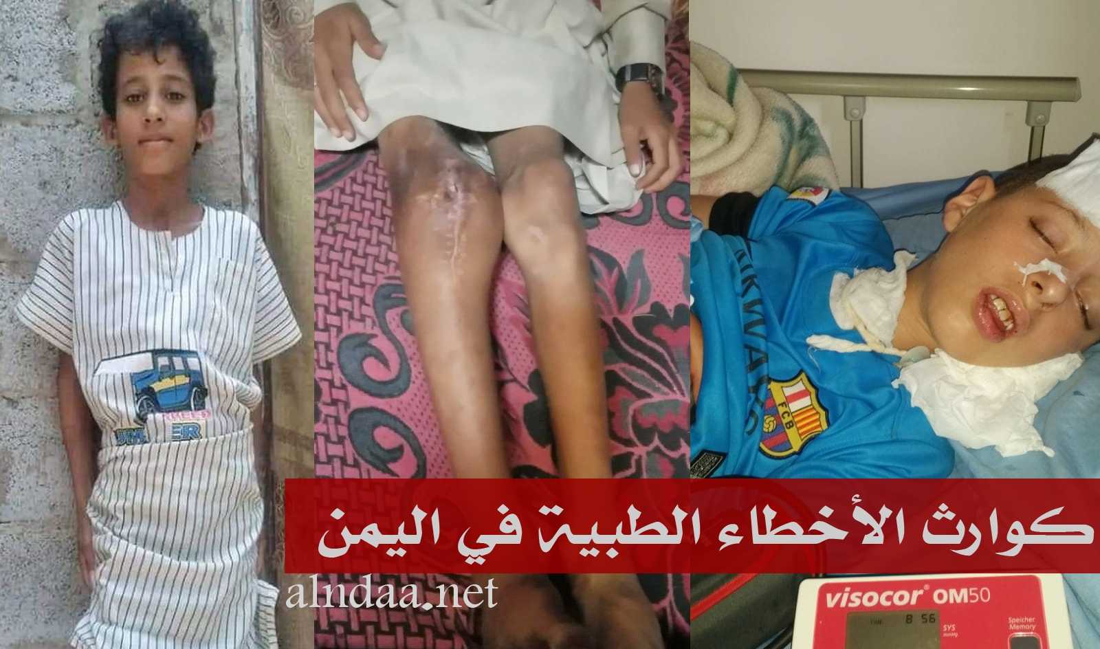 كوارث الأخطاء الطبية في اليمن - الطفلان المقالح والقطوي شاهدان