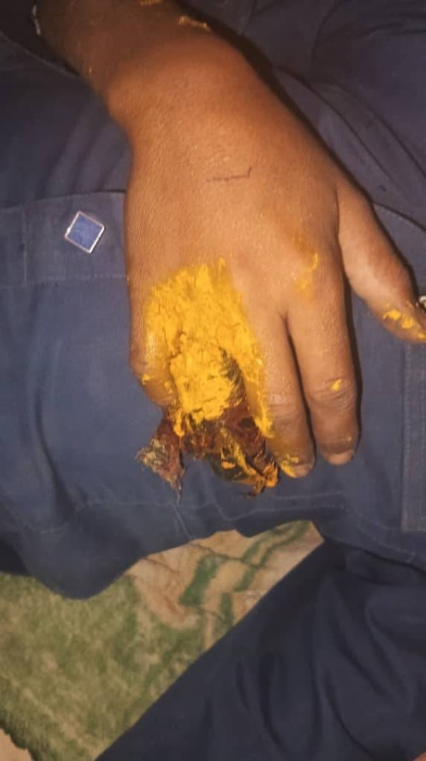 يد الطفل المصابة