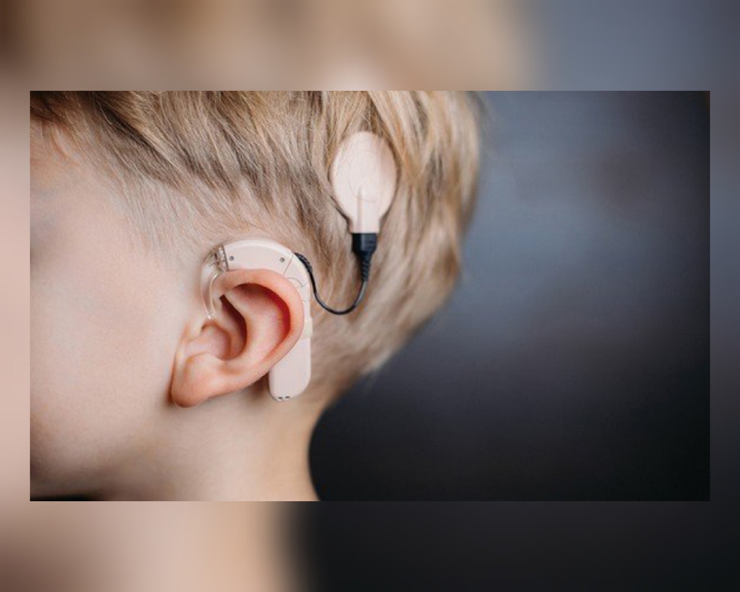 زراعة القوقعة الإلكترونية تفتح أبواب السمع لأول مرة في اليمن